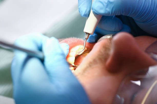 Best Broken or Chipped Tooth Repair in Clarence, IA