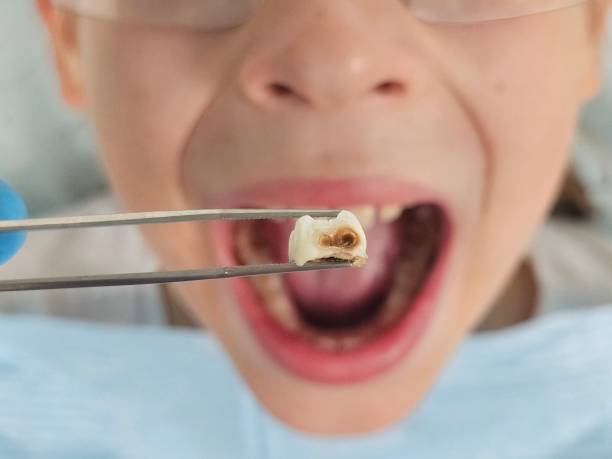 Best Emergency Root Canal Therapy in Clarence, IA